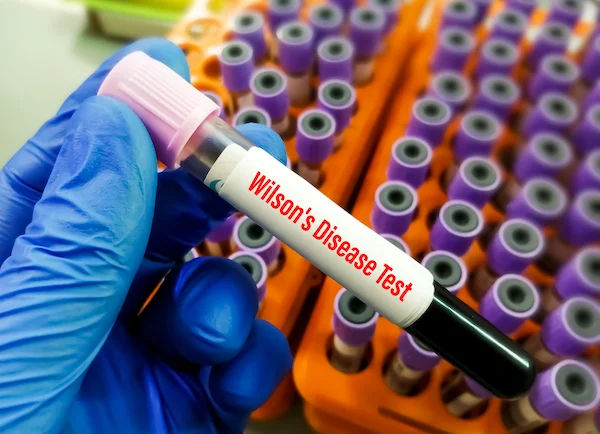 Symptoms, Causes, and Treatment of Wilson's Disease