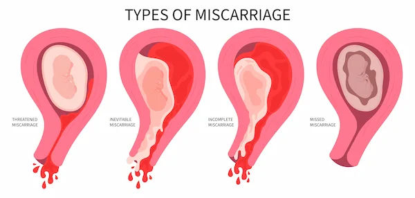 Implantation Bleeding: Symptoms, Causes, and Treatment