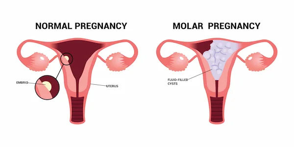 Molar Pregnancy: Overview of Symptoms and Treatments