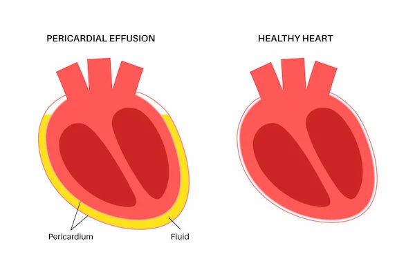 Pericardial Effusion Overview and Management