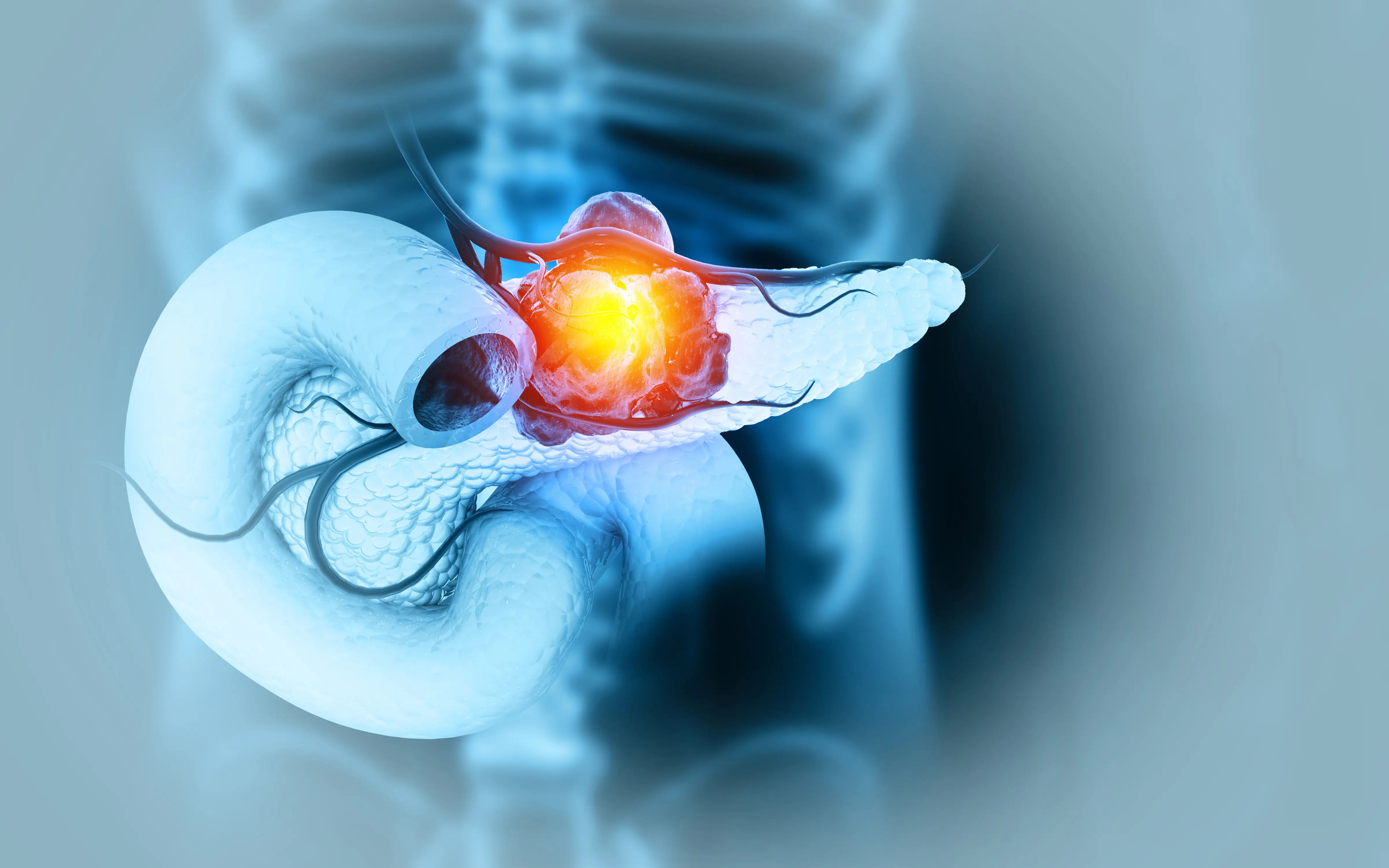 Pancreatic Cancer: