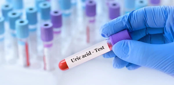 uric acid test