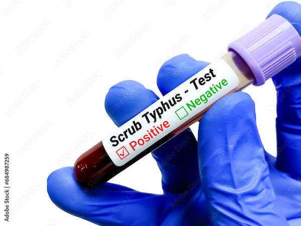 Scrub Typhus Overview and Management
