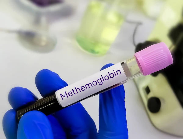 Methemoglobinemia