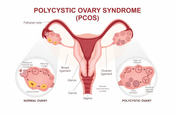 Black Period Blood and PCOS Explained