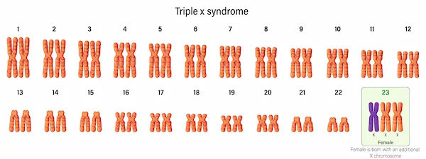 Triple X Syndrome: Key Facts and Insights