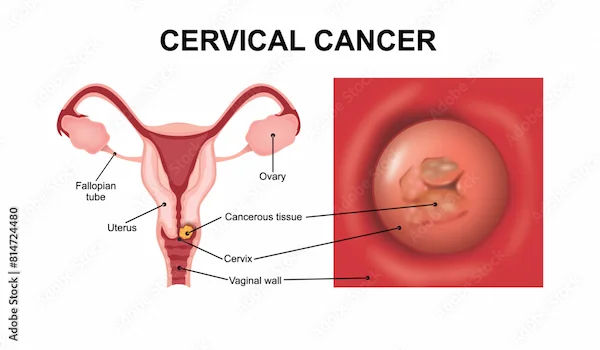Cervical Cancer Day Observance and Awareness