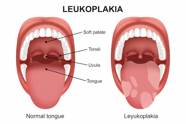 Leukoplakia: Overview of Causes and Treatment