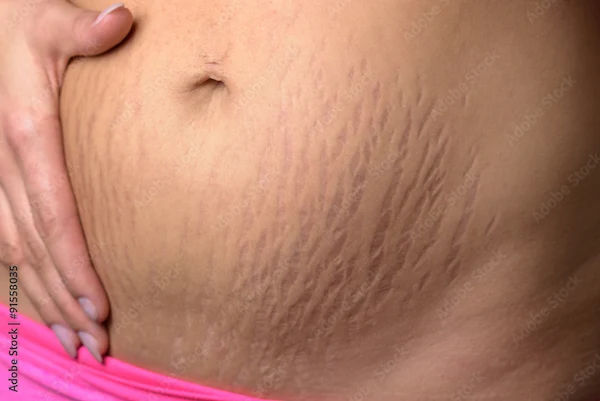 Understanding Pregnancy Stretch Marks and Treatments