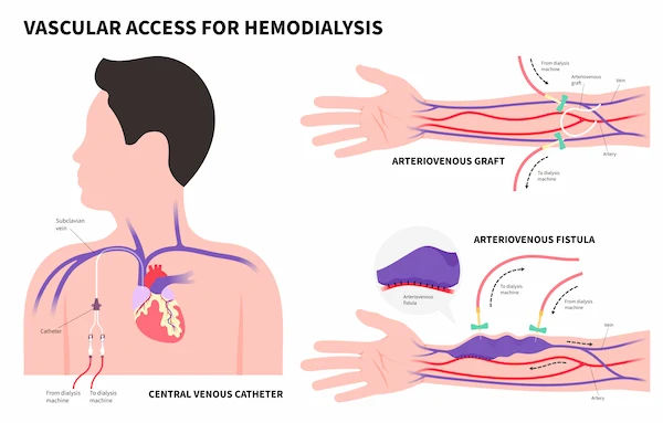 Types of Dialysis Explained