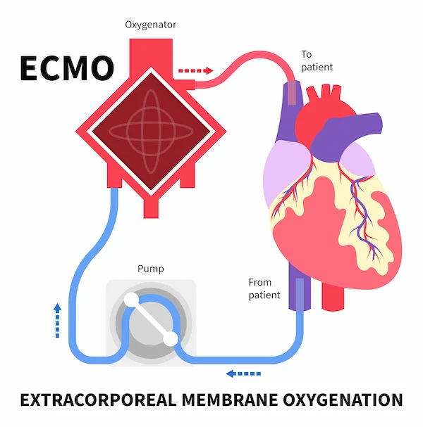 Understanding ECMO Therapy in COVID-19