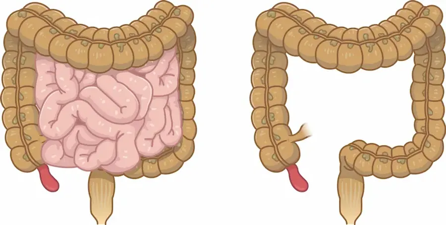 Porcelain Appendix Understanding Appendicitis Symptoms, Causes, and Treatment
