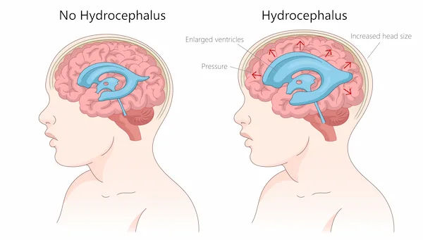 Hydrocephalus Overview and Treatment Options