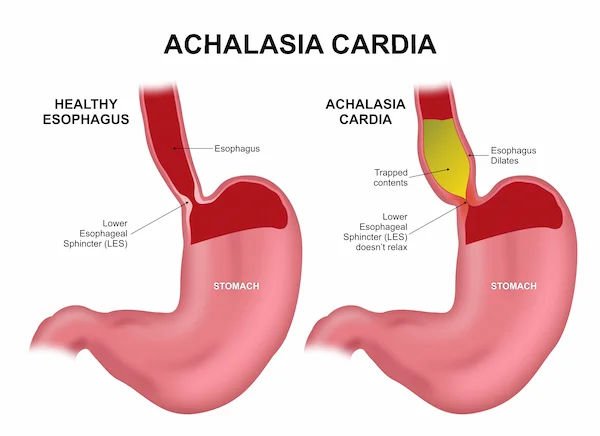 Achalasia Cardia: Symptoms, Diagnosis, and Treatment Guide