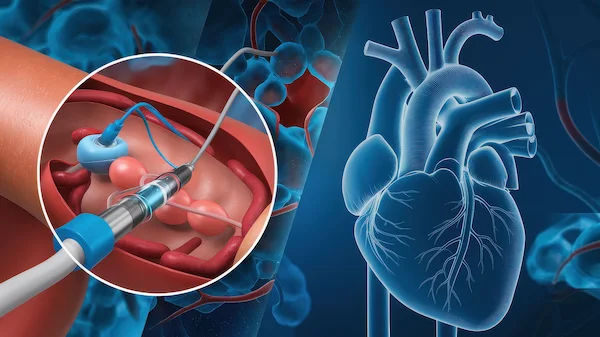 MICS Heart Surgery: Benefits, Risks, and Recovery Explained