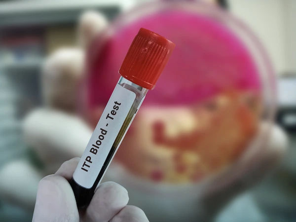 Immune Thrombocytopenic Purpura (ITP): Causes, Symptoms, and Treatment