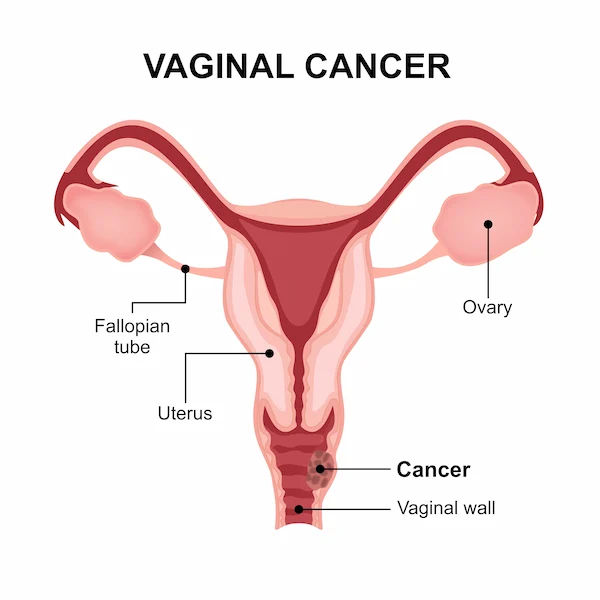 What Leads To Signs Of Vaginal Cancer?