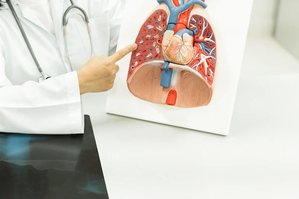 pleural effusion