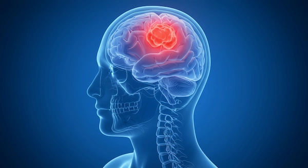 Brain Tumors