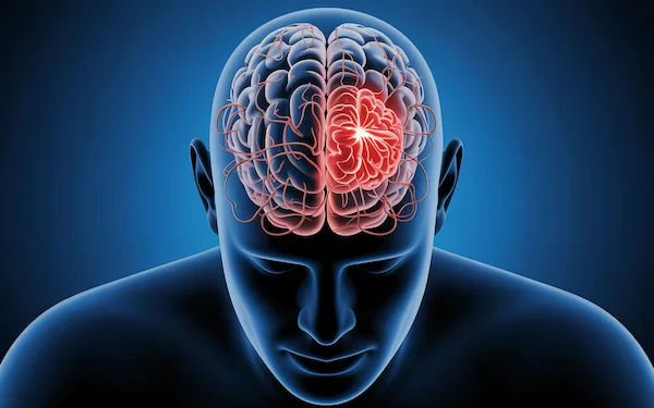 Brain Stroke Act Time: A Life-Saving Guide to F.A.S.T