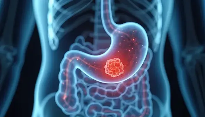 Stomach Cancer Treatment Delhi