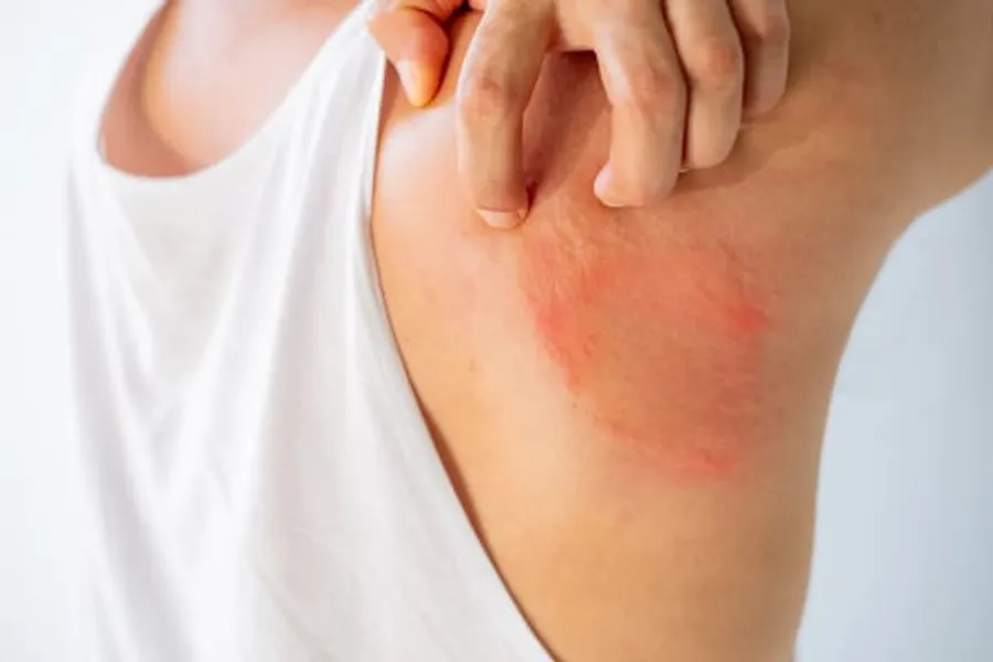 Heat Rash Underline Ring Rach Understanding Heat Rashes