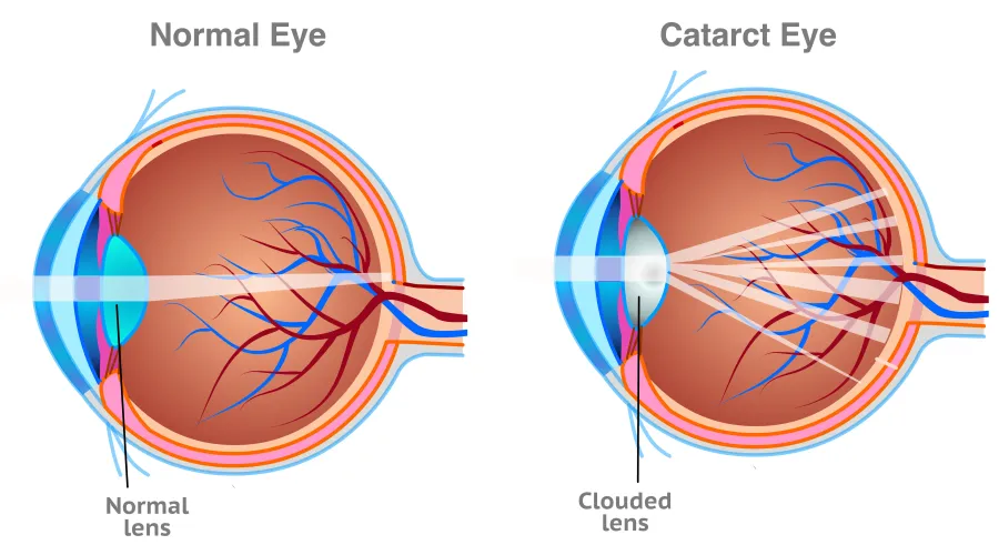 Improved Distance Vision Poor Distance Vision After Cataract Surgery