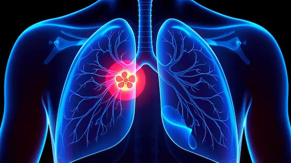 Emphysema