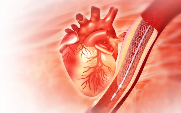 angioplasty