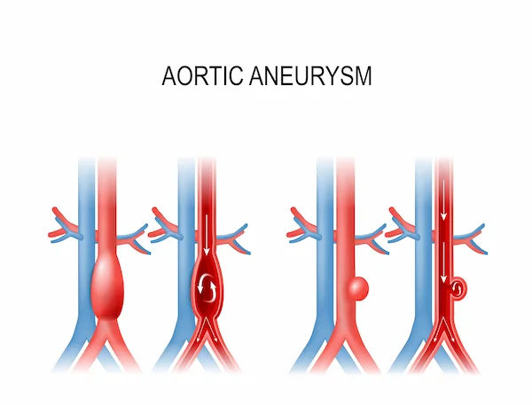 What Leads To Signs Of Aneurysms And Types