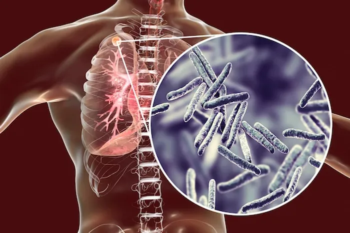 tuberculosis