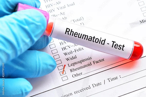 Understanding the Rheumatoid Factor Test