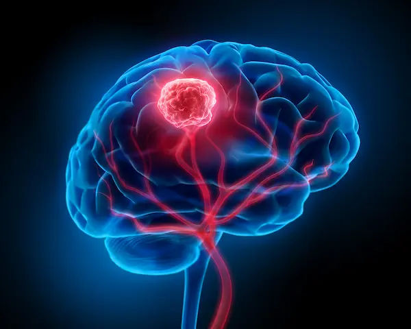 Brain Tumor