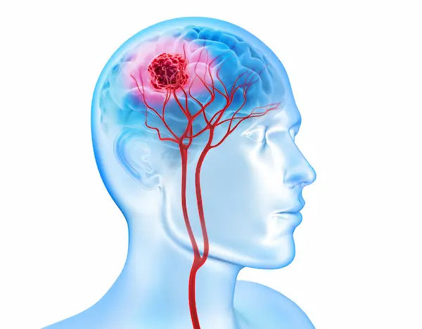 Brain Tumor Mean I Am Suffering Cancer