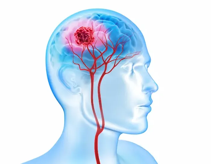 Brain Tumor Mean I Am Suffering Cancer