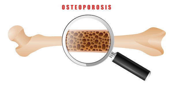 osteoporosis