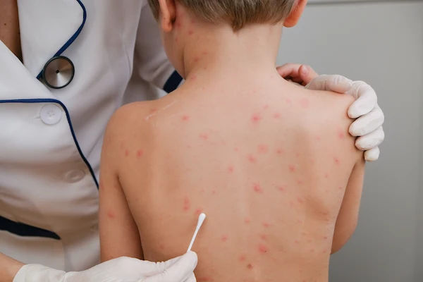 Chickenpox