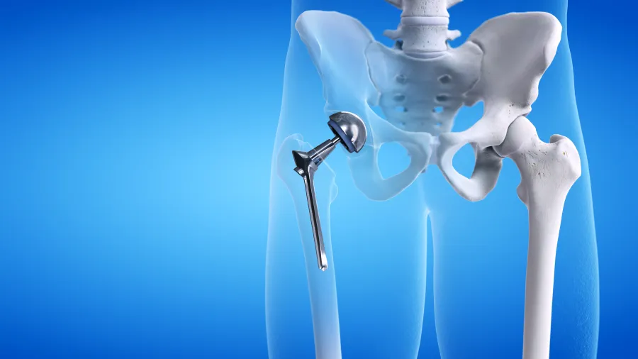 Hip Replacement Surgery After 6 Weeks