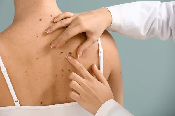 Skin Cancer