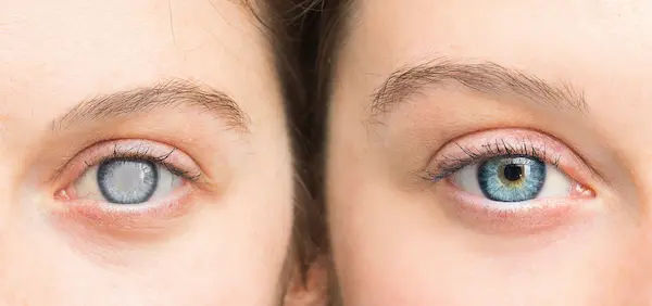 Cataract
