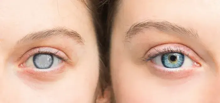 Cataract