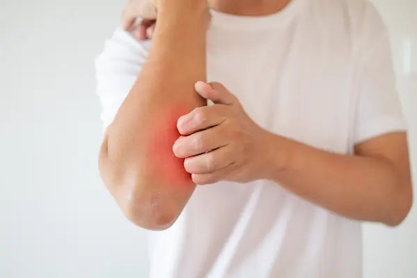 Skin Infections