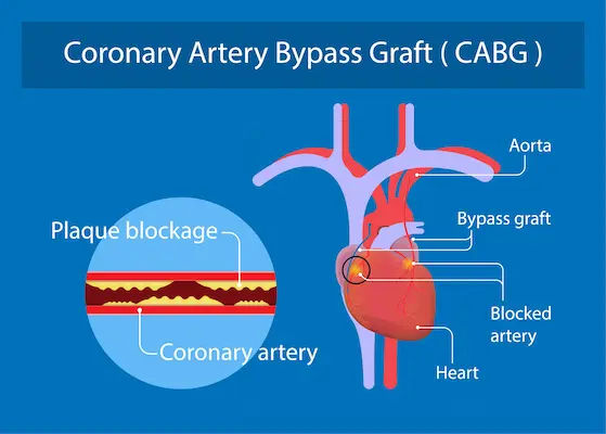 Guide to Myths And Facts Of Coronary Artery Bypass Grafting