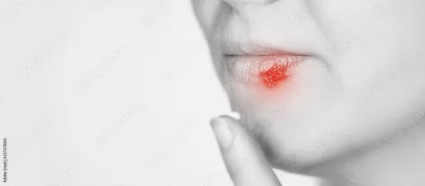 Natural Mouth Ulcer Treatments: Soothe Pain and Heal Faster