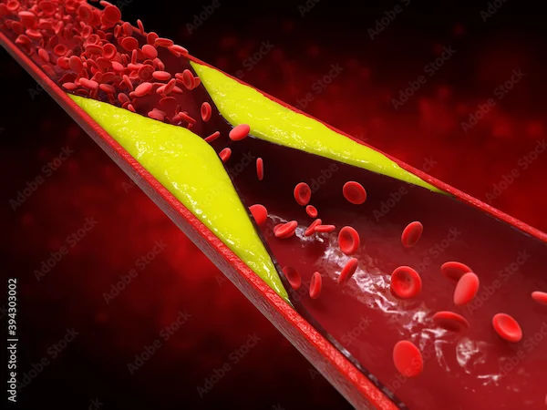 Causes of Heart Blockage Explained