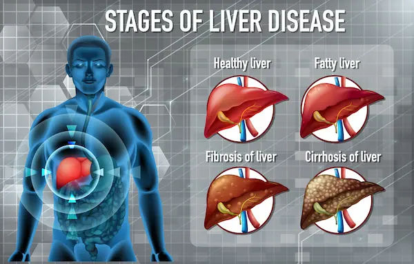 Stages Alcoholic Liver Disease