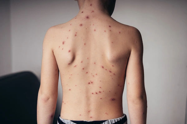 chickenpox