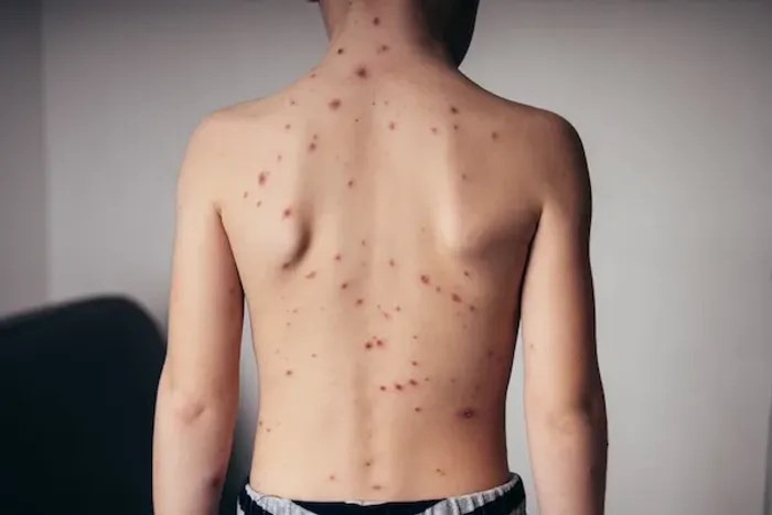 Chickenpox Signs and Prevention: A Complete Guide