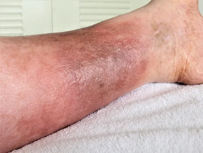 cellulitis