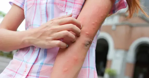 Allergic Reactions To Insect Bites